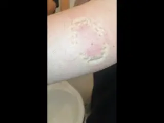 Girl Hard Biting Marks