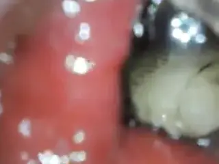 anal endoscope ass play from inside