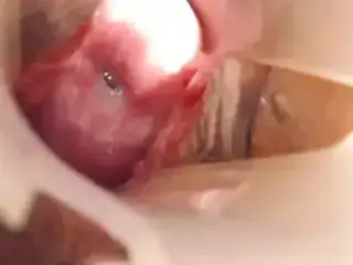 Long cervix show, speculum and try to insert pencil